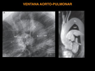 Radiografía lateral de tórax. Anatomía radiográﬁca
A B
C
D
BLM
BLID
VI
VCI
RC
BLII
BLII
BLM
s
BPI
I
BLSI
Figura 13 Área re...