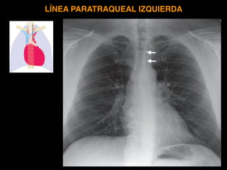 As with the right paratra-
cheal stripe, abnormal contour or widening is
commonly seen in large left-sided pleural effu-
s...