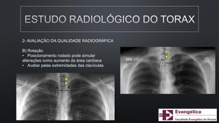 2- AVALIAÇÃO DA QUALIDADE RADIOGRÁFICA
B) Rotação
• Posicionamento rodado pode simular
alterações como aumento da área cardíaca
• Avaliar pelas extremidades das clavículas
 