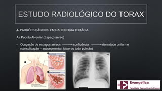 4- PADRÕES BÁSICOS EM RADIOLOGIA TORÁCIA
A) Padrão Alveolar (Espaço aéreo)
- Ocupação de espaços aéreos confluência densidade uniforme
(consolidação – subsegmentar, lobar ou todo pulmão)
 