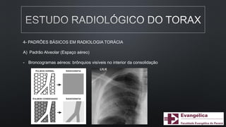 4- PADRÕES BÁSICOS EM RADIOLOGIA TORÁCIA
A) Padrão Alveolar (Espaço aéreo)
- Broncogramas aéreos: brônquios visíveis no interior da consolidação
 