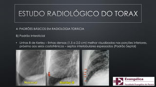 4- PADRÕES BÁSICOS EM RADIOLOGIA TORÁCIA
B) Padrão Intersticial
• Linhas B de Kerley – linhas densas (1,5 a 2,0 cm) melhor visualizadas nas porções inferiores,
próximo aos seios costofrênicos – septos interlobulares espessados (Padrão Septal)
 