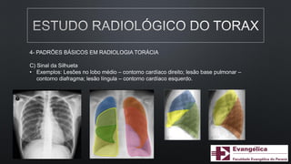 4- PADRÕES BÁSICOS EM RADIOLOGIA TORÁCIA
C) Sinal da Silhueta
• Exemplos: Lesões no lobo médio – contorno cardíaco direito; lesão base pulmonar –
contorno diafragma; lesão língula – contorno cardíaco esquerdo.
 