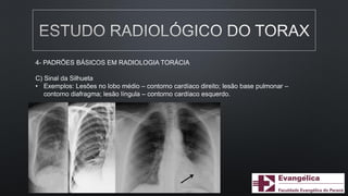 4- PADRÕES BÁSICOS EM RADIOLOGIA TORÁCIA
C) Sinal da Silhueta
• Exemplos: Lesões no lobo médio – contorno cardíaco direito; lesão base pulmonar –
contorno diafragma; lesão língula – contorno cardíaco esquerdo.
 