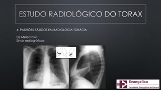 4- PADRÕES BÁSICOS EM RADIOLOGIA TORÁCIA
D) Atelectasia
Sinais radiográficos:
 