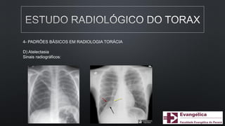 4- PADRÕES BÁSICOS EM RADIOLOGIA TORÁCIA
D) Atelectasia
Sinais radiográficos:
 