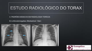4- PADRÕES BÁSICOS EM RADIOLOGIA TORÁCIA
E) Linfonodomegalias (Mediastinal / hilar)
 