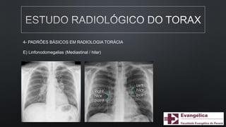 4- PADRÕES BÁSICOS EM RADIOLOGIA TORÁCIA
E) Linfonodomegalias (Mediastinal / hilar)
 