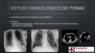 4- PADRÕES BÁSICOS EM RADIOLOGIA TORÁCIA
F) Nódulos
• Nódulo Pulmonar solitário : avaliar tamanho, contorno, forma, densidade e presença
escavação ou calcificação.
 