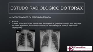 4- PADRÕES BÁSICOS EM RADIOLOGIA TORÁCIA
F) Nódulos
• Grandes nódulos múltiplos: metástases hematogênicas (principal causa) – mais frequente
em bases e periferias, com tamanhos variados; embolia séptica; doenças infecciosas
(aspergilose).
 