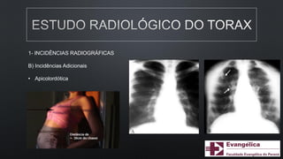1- INCIDÊNCIAS RADIOGRÁFICAS
B) Incidências Adicionais
• Apicolordótica
 