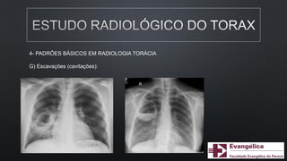 4- PADRÕES BÁSICOS EM RADIOLOGIA TORÁCIA
G) Escavações (cavitações):
 