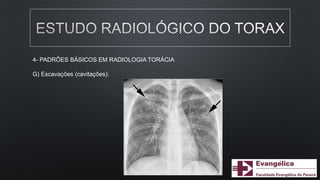 4- PADRÕES BÁSICOS EM RADIOLOGIA TORÁCIA
G) Escavações (cavitações):
 