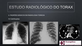 4- PADRÕES BÁSICOS EM RADIOLOGIA TORÁCIA
H) Calcificações:
 