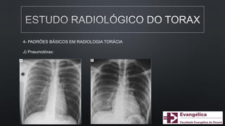 4- PADRÕES BÁSICOS EM RADIOLOGIA TORÁCIA
J) Pneumotórax:
 