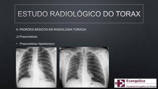 4- PADRÕES BÁSICOS EM RADIOLOGIA TORÁCIA
J) Pneumotórax:
• Pneumotórax hipertensivo:
 