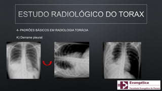 4- PADRÕES BÁSICOS EM RADIOLOGIA TORÁCIA
K) Derrame pleural:
 