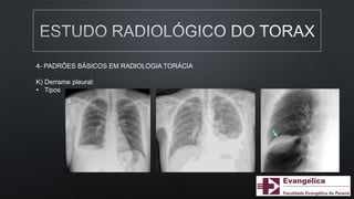 4- PADRÕES BÁSICOS EM RADIOLOGIA TORÁCIA
K) Derrame pleural:
• Tipos
 