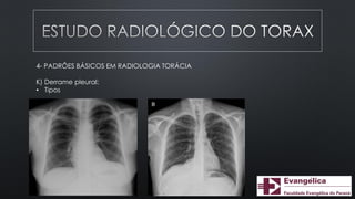 4- PADRÕES BÁSICOS EM RADIOLOGIA TORÁCIA
K) Derrame pleural:
• Tipos
 