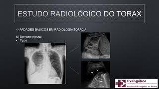 4- PADRÕES BÁSICOS EM RADIOLOGIA TORÁCIA
K) Derrame pleural:
• Tipos
 