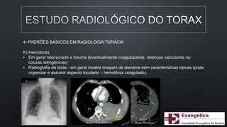 4- PADRÕES BÁSICOS EM RADIOLOGIA TORÁCIA
K) Hemotórax:
• Em geral relacionado a trauma (eventualmente coagulopatias, doenças vasculares ou
causas iatrogênicas)
• Radiografia de toráx : em geral mostra imagem de derrame sem características típicas (pode
organizar e assumir aspecto loculado – hemotórax coagulado).
 