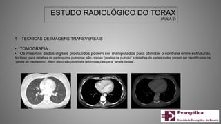 ESTUDO RADIOLÓGICO DO TORAX
(AULA 2)
1 – TÉCNICAS DE IMAGENS TRANSVERSAIS
• TOMOGRAFIA :
• Os mesmos dados digitais produzidos podem ser manipulados para otimizar o contrate entre estruturas.
No tórax, para detalhes do parênquima pulmonar, são criadas “janelas de pulmão” e detalhes de partes moles podem ser identificadas na
“janela de mediastino”. Além disso são possíveis reformatações para “janela óssea”.
 