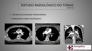 ESTUDO RADIOLÓGICO DO TORAX
(AULA 2)
1 – TÉCNICAS DE IMAGENS TRANSVERSAIS
• TOMOGRAFIA COMPUTADORIZADA:
 