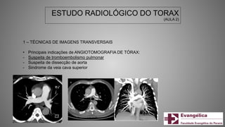 ESTUDO RADIOLÓGICO DO TORAX
(AULA 2)
1 – TÉCNICAS DE IMAGENS TRANSVERSAIS
• Principais indicações de ANGIOTOMOGRAFIA DE TÓRAX:
- Suspeita de tromboembolismo pulmonar
- Suspeita de dissecção de aorta
- Sindrome da veia cava superior
 
