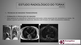 ESTUDO RADIOLÓGICO DO TORAX
(AULA 2)
1 – TÉCNICAS DE IMAGENS TRANSVERSAIS
• FORMAÇÃO E PRODUÇÃO DE IMAGEM
• Cada sequencia de ressonância é relativamente demorada e várias sequencias não necessárias por exame . No
entanto a grande quantidade de sequencias utilizadas pode fornecer um melhor levantamento anatômico.
 