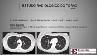ESTUDO RADIOLÓGICO DO TORAX
(AULA 2)
2 – TOMOGRAFIA DE TÓRAX E TÉCNICA DE ALTA RESOLUÇÃO DOS PULMÕES
Janela de pulmão
Nota: quando a imagem de TC está perpendicular a uma estrutura cilíndrica (vaso ou brônquio) ela aparece
como um círculo.
 