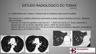 ESTUDO RADIOLÓGICO DO TORAX
(AULA 2)
2 – TOMOGRAFIA DE TÓRAX E TÉCNICA DE ALTA RESOLUÇÃO DOS PULMÕES
Para maximizar os detalhes anatômicos pulmonares e avaliar doença intersticial pulmonar, utilizamos
duas estratégias:
- Obtenção de cortes tomográficos mais finos (0,5 - 1,25mm em vez de 2,5 - 5mm), diminuindo a
sobreposição com os tecidos adjacentes (reduz o efeito de volume parcial)
- Usamos algoritmo de reconstrução a fim de aumentar a nitidez as interfaces (algoritmo de frequência
espacial alta ou ALTA RESOLUÇÃO).
 