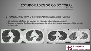 ESTUDO RADIOLÓGICO DO TORAX
(AULA 2)
2 – TOMOGRAFIA DE TÓRAX E TÉCNICA DE ALTA RESOLUÇÃO DOS PULMÕES
- As aquisições são feitas em apnéia e em inspiração máxima (reduz artefatos).
- Quando há suspeita de obstrução de pequenas vias aérea, as imagens podem ser obtidas também
em expiração
 
