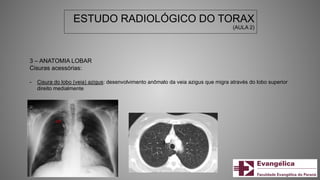 ESTUDO RADIOLÓGICO DO TORAX
(AULA 2)
3 – ANATOMIA LOBAR
Cisuras acessórias:
- Cisura do lobo (veia) azigus: desenvolvimento anômalo da veia azigus que migra através do lobo superior
direito medialmente
 