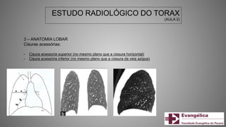 ESTUDO RADIOLÓGICO DO TORAX
(AULA 2)
3 – ANATOMIA LOBAR
Cisuras acessórias:
- Cisura acessoria superior (no mesmo plano que a cissura horizontal)
- Cisura acessória inferior (no mesmo plano que a cissura da veia azigus)
 