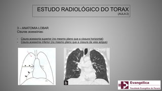 ESTUDO RADIOLÓGICO DO TORAX
(AULA 2)
3 – ANATOMIA LOBAR
Cisuras acessórias:
- Cisura acessoria superior (no mesmo plano que a cissura horizontal)
- Cisura acessória inferior (no mesmo plano que a cissura da veia azigus)
 