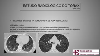 ESTUDO RADIOLÓGICO DO TORAX
(AULA 2)
4 – PADRÕES BÁSICOS NA TOMOGRAFIA DE ALTA RESOLUÇÃO:
c) Padrão cístico:
Cistos – Espaços arredondados e com paredes definidas (≠ enfisema)
Em geral, se difuso está associado a um grupo definido de doenças (Histiocitose de Células de Langerhans,
Linfangioliomiomatose, pneumonia intersticial linfocítica e pneumocistose)
 