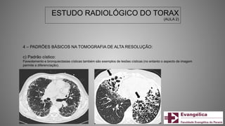 ESTUDO RADIOLÓGICO DO TORAX
(AULA 2)
4 – PADRÕES BÁSICOS NA TOMOGRAFIA DE ALTA RESOLUÇÃO:
c) Padrão cístico:
Faveolamento e bronquiectasias císticas também são exemplos de lesões císticas (no entanto o aspecto de imagem
permite a diferenciação).
 