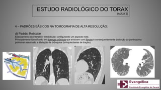 ESTUDO RADIOLÓGICO DO TORAX
(AULA 2)
4 – PADRÕES BÁSICOS NA TOMOGRAFIA DE ALTA RESOLUÇÃO:
d) Padrão Reticular
Epessamento do interstício intralobular, configurando um aspecto rede.
Principalmente identificado em doenças crônicas que evoluem com fibrose e consequentemente distorção do parênquima
pulmonar associado a dilatação de brônquios (brinquiectasias de tração).
 