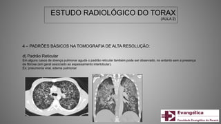 ESTUDO RADIOLÓGICO DO TORAX
(AULA 2)
4 – PADRÕES BÁSICOS NA TOMOGRAFIA DE ALTA RESOLUÇÃO:
d) Padrão Reticular
Em alguns casos de doença pulmonar aguda o padrão reticular também pode ser observado, no entanto sem a presença
de fibrose (em geral associado ao espessamento interlobular).
Ex: pneumonia viral, edema pulmonar
 
