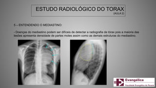 ESTUDO RADIOLÓGICO DO TORAX
(AULA 2)
5 – ENTENDENDO O MEDIASTINO:
- Doenças do mediastino podem ser difíceis de detectar a radiografia de tórax pois a maioria das
lesões apresenta densidade de partes moles assim como as demais estruturas do mediastino.
 