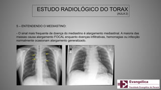 ESTUDO RADIOLÓGICO DO TORAX
(AULA 2)
5 – ENTENDENDO O MEDIASTINO:
- O sinal mais frequente de doença do mediastino é alargamento mediastinal. A maioria das
massas causa alargamento FOCAL enquanto doenças infiltrativas, hemorragias ou infecção
normalmente ocasionam alargamento generalizado.
 