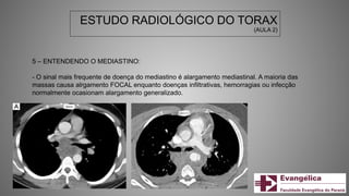 ESTUDO RADIOLÓGICO DO TORAX
(AULA 2)
5 – ENTENDENDO O MEDIASTINO:
- O sinal mais frequente de doença do mediastino é alargamento mediastinal. A maioria das
massas causa alrgamento FOCAL enquanto doenças infiltrativas, hemorragias ou infecção
normalmente ocasionam alargamento generalizado.
 
