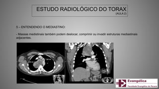 ESTUDO RADIOLÓGICO DO TORAX
(AULA 2)
5 – ENTENDENDO O MEDIASTINO:
- Massas medistinais também podem deslocar, comprimir ou invadir estruturas mediastinais
adjacentes.
 