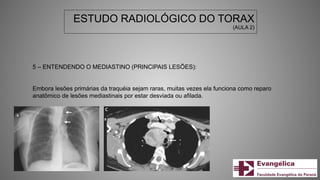 ESTUDO RADIOLÓGICO DO TORAX
(AULA 2)
5 – ENTENDENDO O MEDIASTINO (PRINCIPAIS LESÕES):
Embora lesões primárias da traquéia sejam raras, muitas vezes ela funciona como reparo
anatômico de lesões mediastinais por estar desviada ou afilada.
 