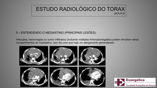 ESTUDO RADIOLÓGICO DO TORAX
(AULA 2)
5 – ENTENDENDO O MEDIASTINO (PRINCIPAIS LESÕES):
Infecções, hemorragias ou tumor infiltrativo (incluindo múltiplas linfonodomegalias) podem envolver vários
compartimentos do mediastino. Isso faz com que haja um alargamento generalizado.
 