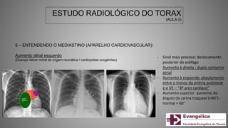 ESTUDO RADIOLÓGICO DO TORAX
(AULA 2)
5 – ENTENDENDO O MEDIASTINO (APARELHO CARDIOVASCULAR):
Aumento atrial esquerdo
(Doença Valvar mitral de origem reumática / cardiopatias congênitas)
- Sinal mais precoce: deslocamento
posterior do esôfago
- Aumento à direita : duplo contorno
atrial
- Aumento à esquerda: abaulamento
entre o tronco da artéria pulmonar
e o VE – “4º arco cardíaco”
- Aumento superior: aumento do
ângulo da carina traqueal (>90°) -
normal = 60°
 