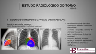 ESTUDO RADIOLÓGICO DO TORAX
(AULA 2)
5 – ENTENDENDO O MEDIASTINO (APARELHO CARDIOVASCULAR):
Aumento ventricular esquerdo
(HAS / Doença Valvar aórtica : insuficiência / estenose)
- Arredondamento do ápice sem
aumento do diâmetro (hipertrofia
concêntrica)
- Aumento à esquerda: aumento do
diâmetro transverso.
- Ápice cardíaco pode deslocar-se
para baixo.
- Aumento posterior promove
ocupação do espaço retrocardíaco,
sem determinar compressão
esofagiana.
 