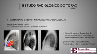 ESTUDO RADIOLÓGICO DO TORAX
(AULA 2)
5 – ENTENDENDO O MEDIASTINO (APARELHO CARDIOVASCULAR):
Aumento ventricular direito
(HAP / estenose de valva pulmonar / cardiopatias congênitas )
- No perfil: aumento da superfície de
contato com o esterno, diminuindo o
espaço hipertransparente retroesternal
(Normlamente o VD deve torcar no
máximo 1/3 do esterno na porção inferior)
 