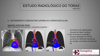 ESTUDO RADIOLÓGICO DO TORAX
(AULA 2)
5 – ENTENDENDO O MEDIASTINO (APARELHO CARDIOVASCULAR):
Aumento ventricular direito
(HAP / estenose de valva pulmonar / cardiopatias congênitas )
- Aumentos mais significativos:
elevação do ápice cardíaco
(“sinal do tamanco holandês”)
- Grandes dilatações do VD há
aumento do diâmetro transverso
do coração, simulando aumento de
VE
 