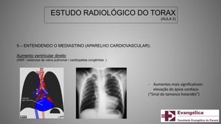 ESTUDO RADIOLÓGICO DO TORAX
(AULA 2)
5 – ENTENDENDO O MEDIASTINO (APARELHO CARDIOVASCULAR):
Aumento ventricular direito
(HAP / estenose de valva pulmonar / cardiopatias congênitas )
- Aumentos mais significativos:
elevação do ápice cardíaco
(“Sinal do tamanco holandês”)
 